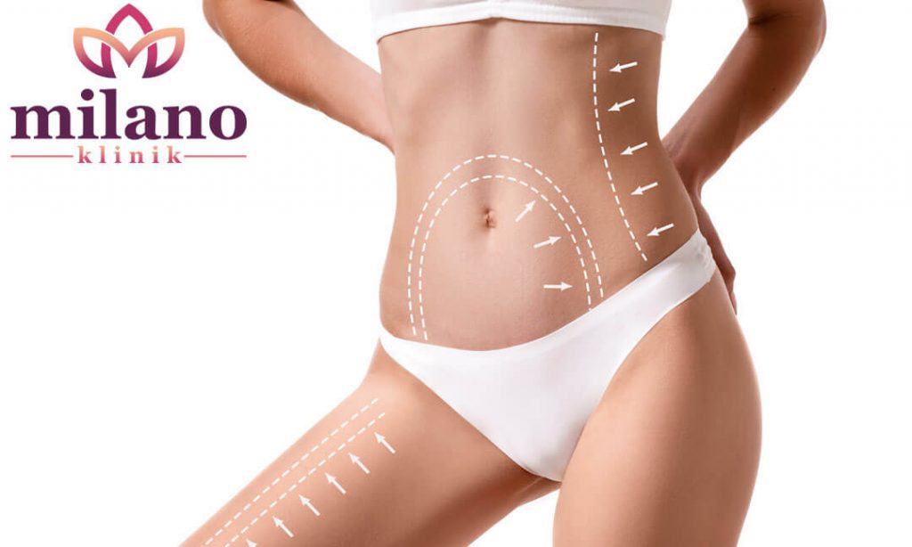 TUMMY TUCK IN DER TÜRKEI