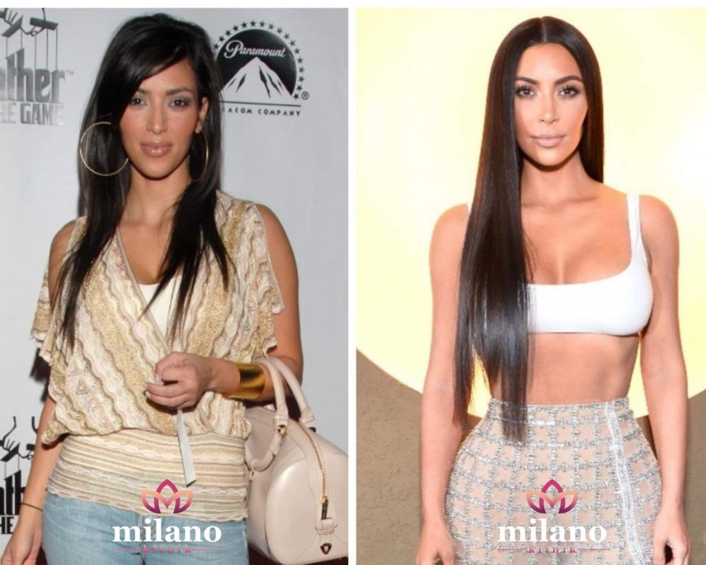 Kim Kardashian Plastic Surgery