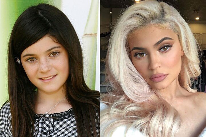 Kylie Jenner’s Plastic Surgeries