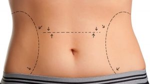 L'abdominoplastie