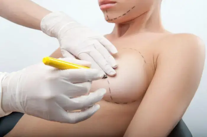 BREAST RECONSTRUCTION SURGERY AFTER BREAST CANCER