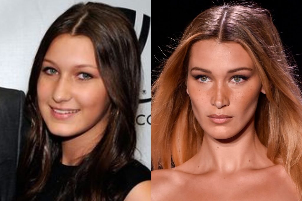 Bella Hadid Plastiche Chirurgie