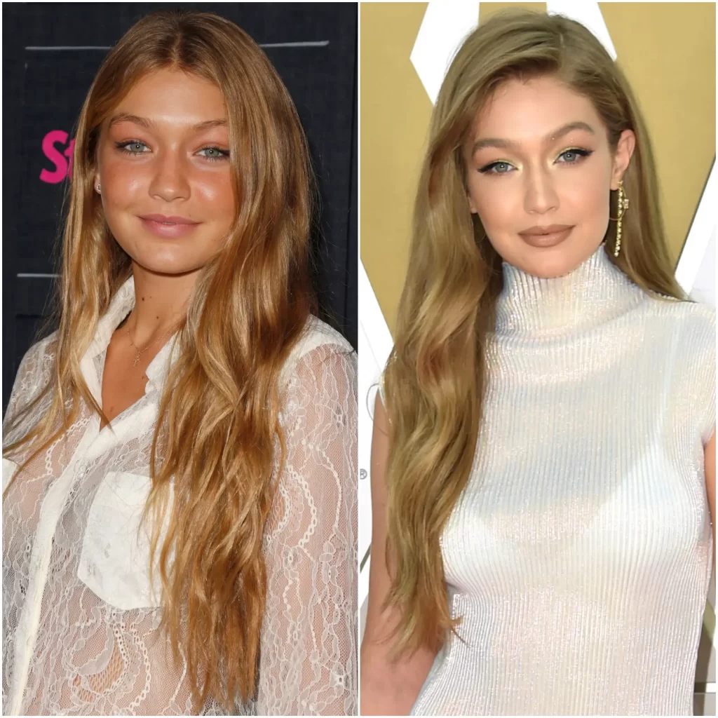 die plastische Chirurgie von Gigi Hadid