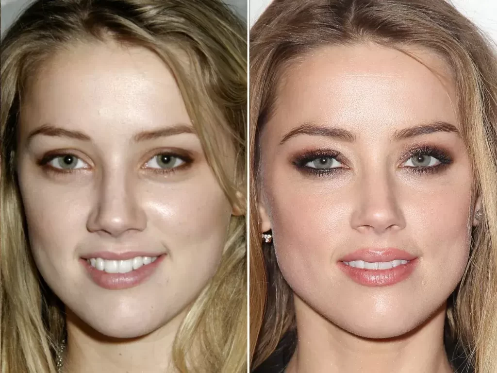 Les chirurgies plastiques Amber Heard