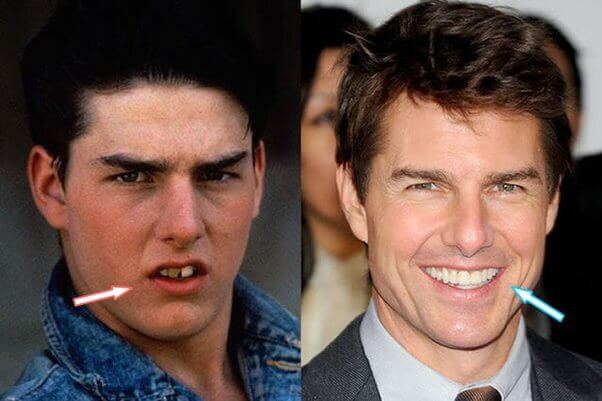 Tom Cruise Plastic Surgery Procedures