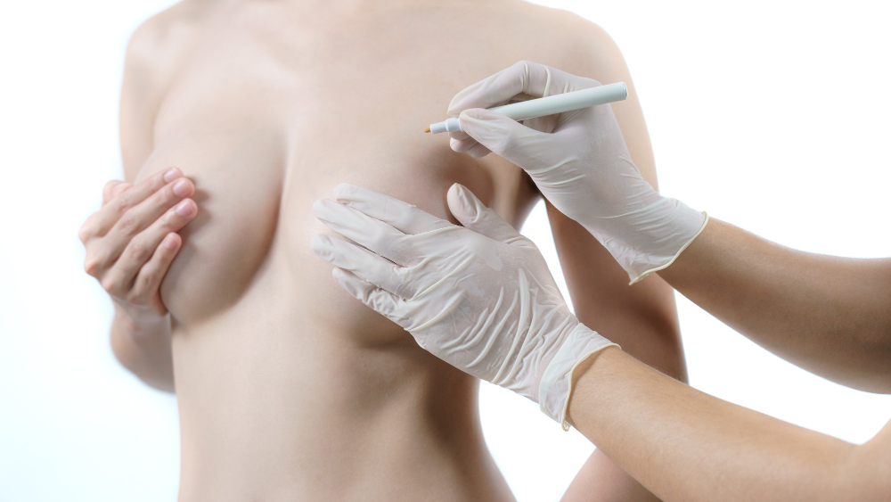 Breast Augmentation 2