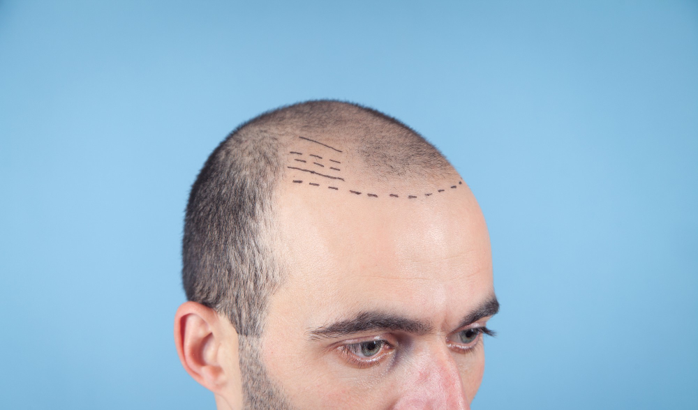 caucasian-bald-man-before-hair-transplantation