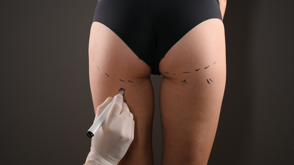 closeup-view-female-buttocks-marked-plastic-operation