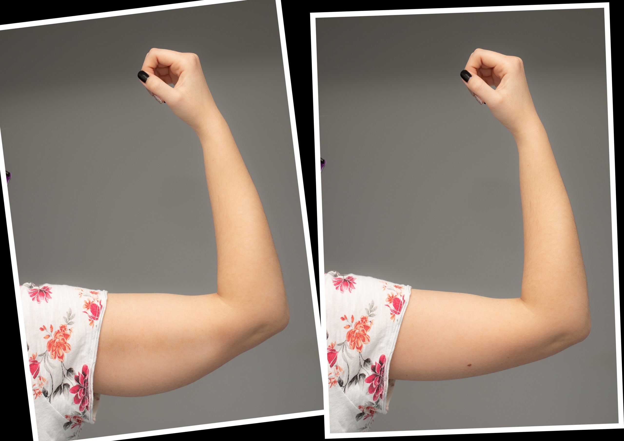 comparison-before-after-excess-skin-removal-arm-results-brachioplasty-surgery-young-caucasian-female-hand-against-grey-background-health-care-conceptxdxa (1)