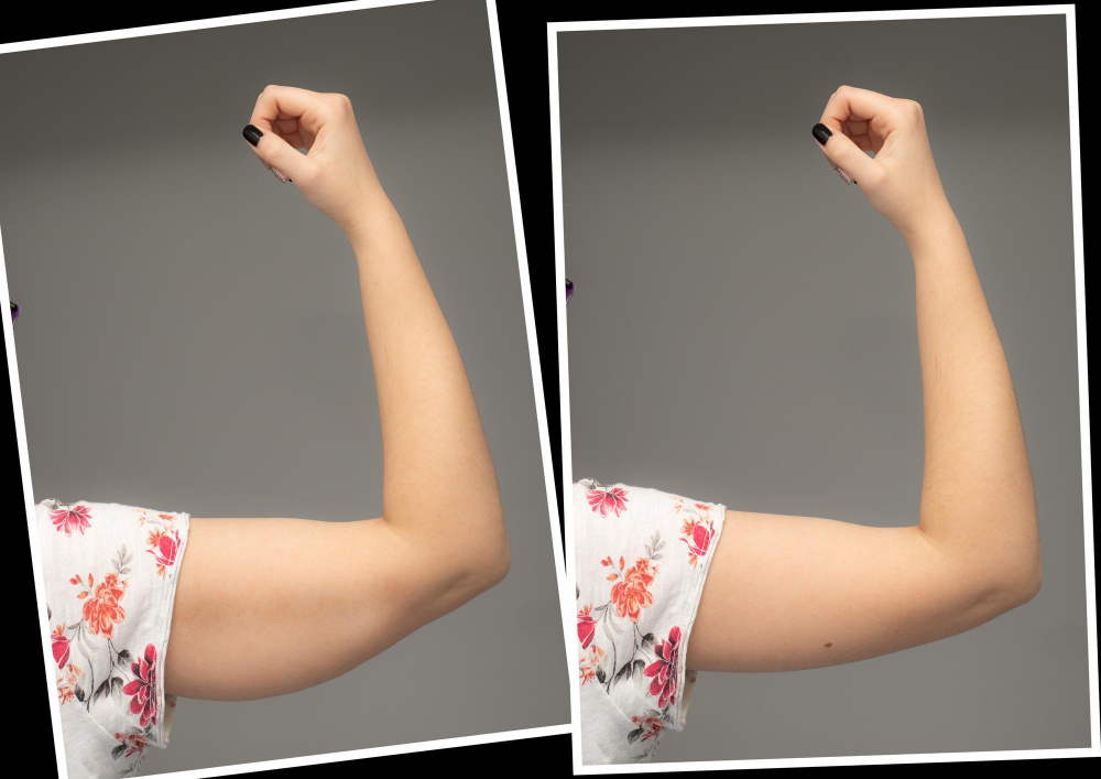 comparison-before-after-excess-skin-removal-arm-results-brachioplasty-surgery-young-caucasian-female-hand-against-grey-background-health-care-conceptxdxa (2)