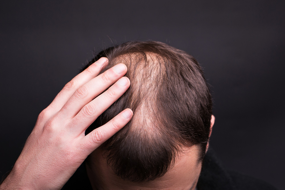 male-head-close-up-with-baldness-studio-black-background