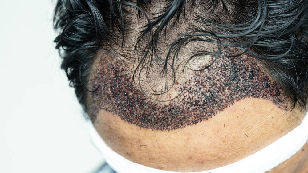 man-head-with-hair-transplant-surgery (1)