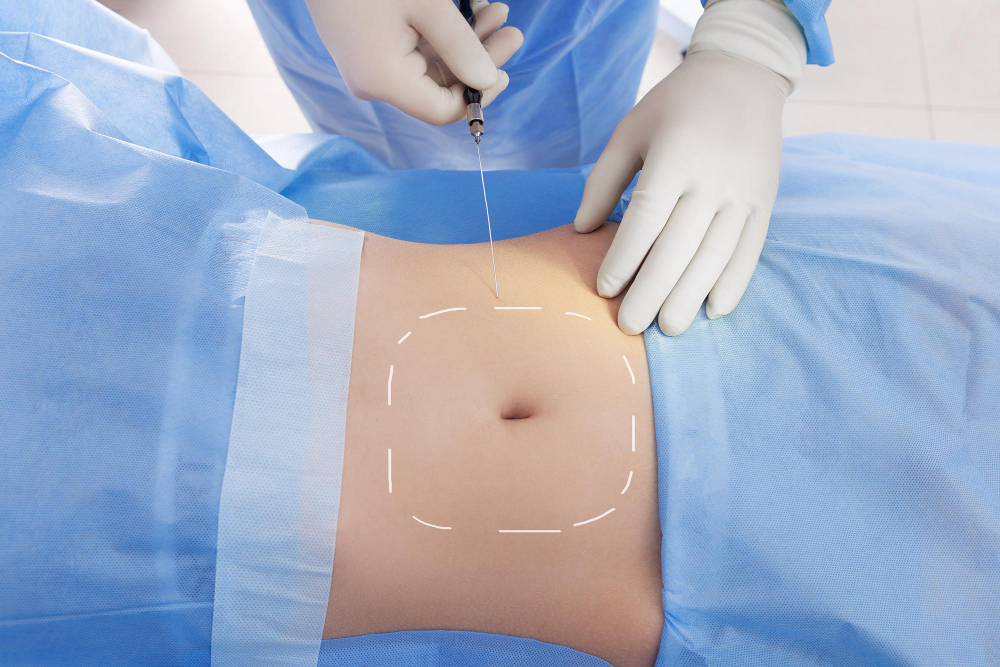 procedure-laser-lipolysis-abdominal-region