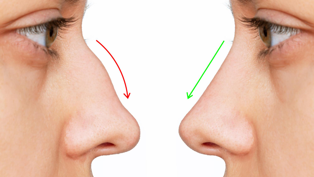 profile-woman-s-face-with-nose-before-after-rhinoplasty-white-background-plastic-surgery