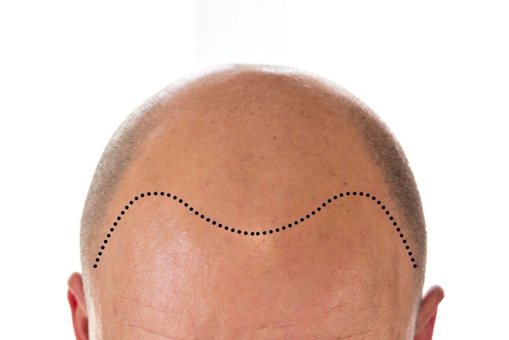 view-bald-man39s-head