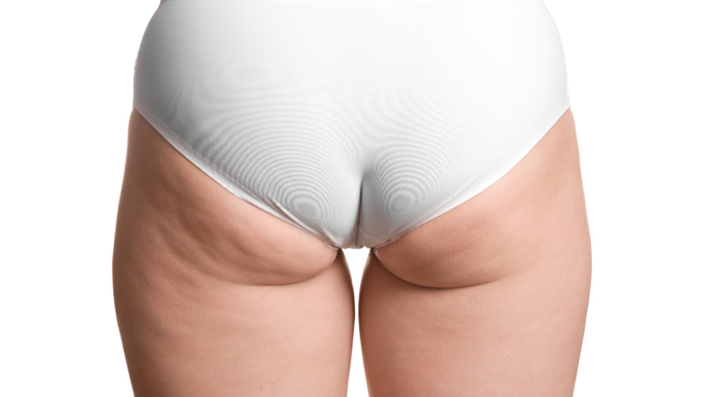 woman-with-cellulite-problem-white-background