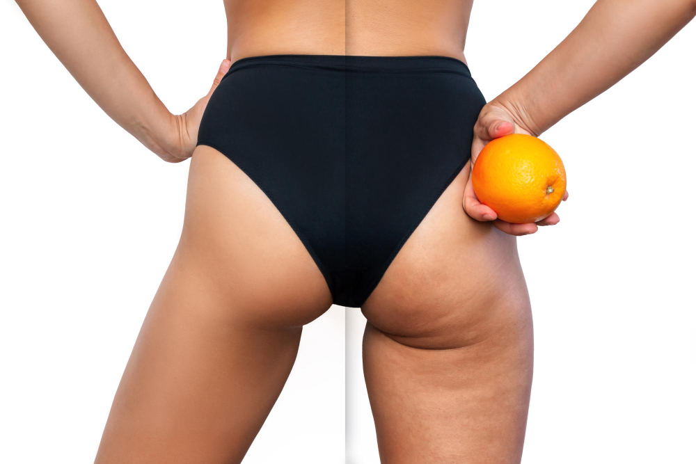 young-woman-with-cellulite-buttocks-thighs-before-after-treatment-holds-orange