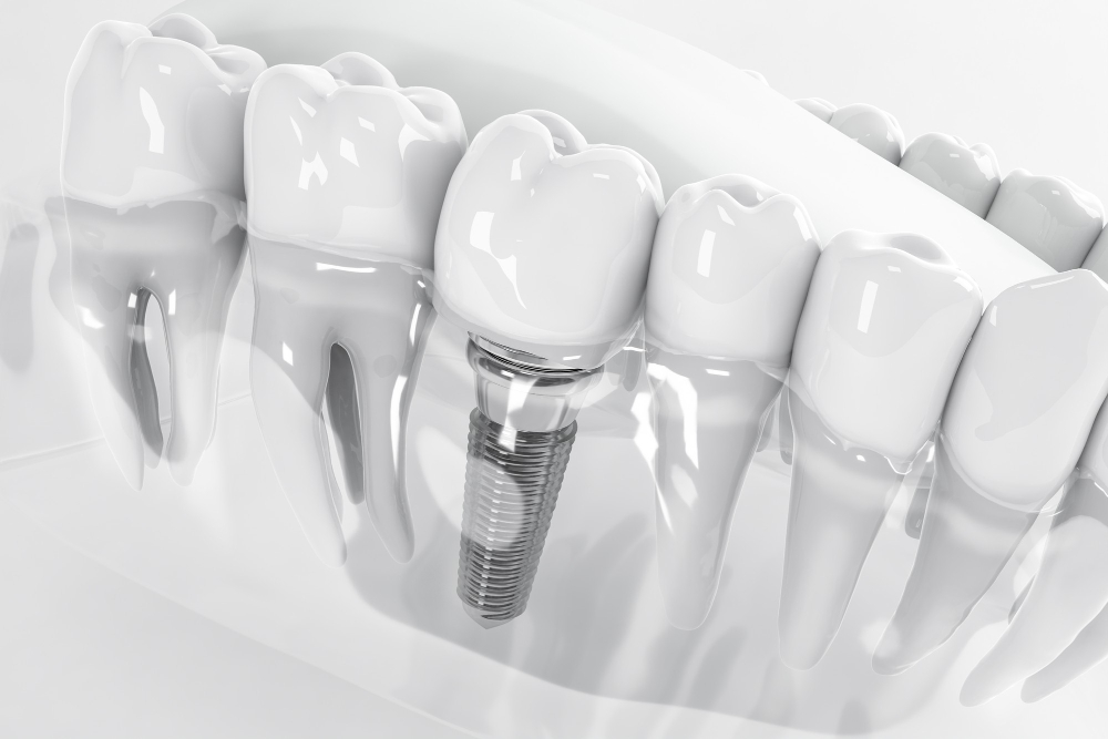 Dental Implants 5