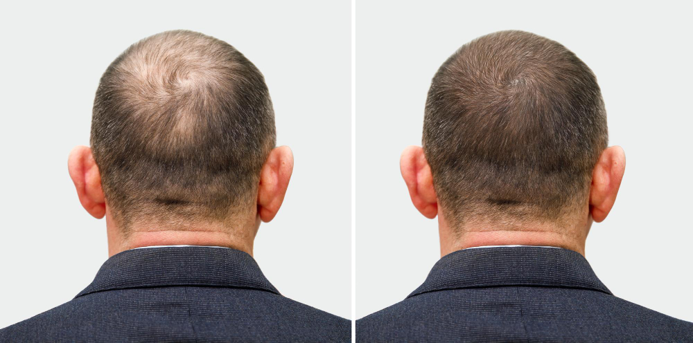 head-balding-man-before-after-hair-transplant-surgery-man-losing-his-hair-has-become