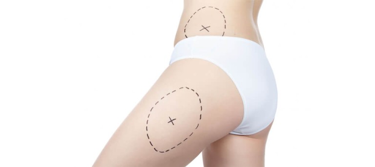 Vaser Hi-Def Liposuction (1)