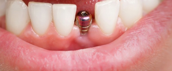 Dentist Tools. Beautiful Young Woman Smile With Closeup Of Tooth Implant For Healthcare Design. Heal