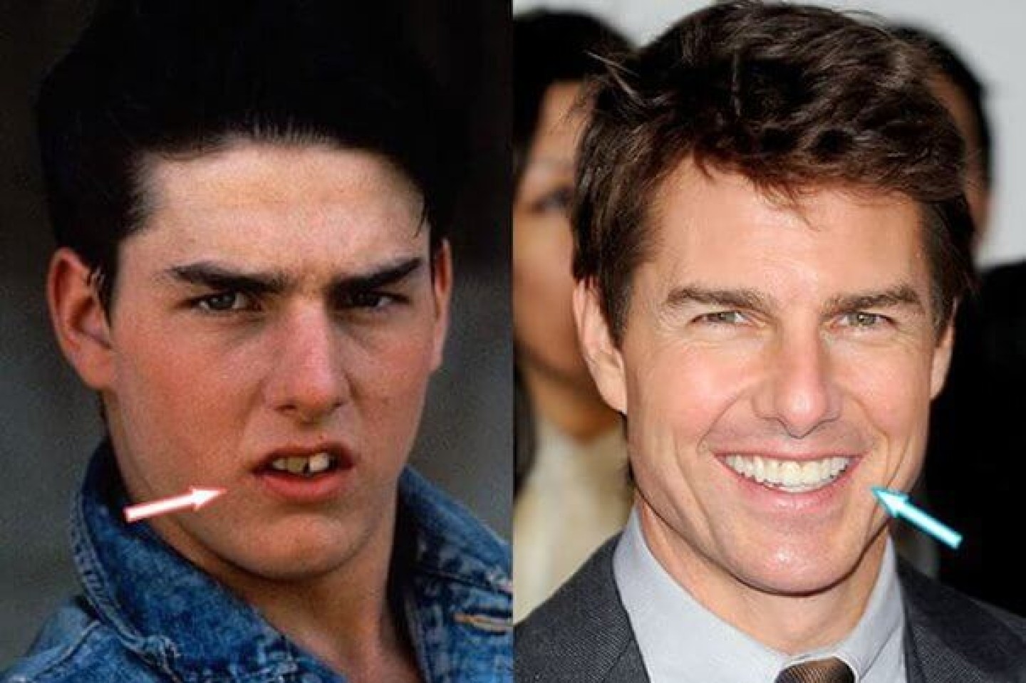 les-chirurgies-plastiques-de-tom-cruise