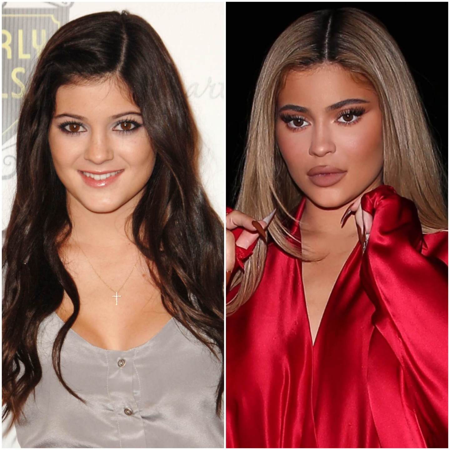 Kylie Jenner’s Plastic Surgeries