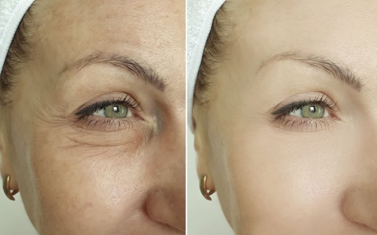 alles-ueber-das-blepharoplastik-verfahren