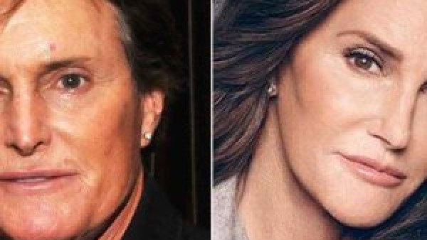 caitlyn-jenner-plastic-surgery